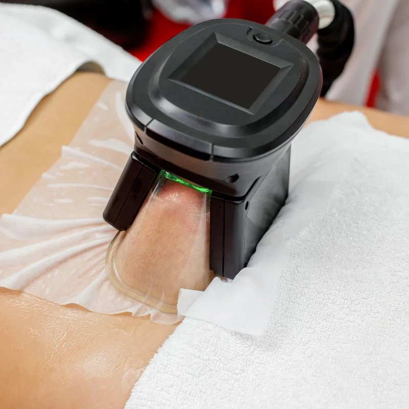 Fat Freezing treatment Swansea